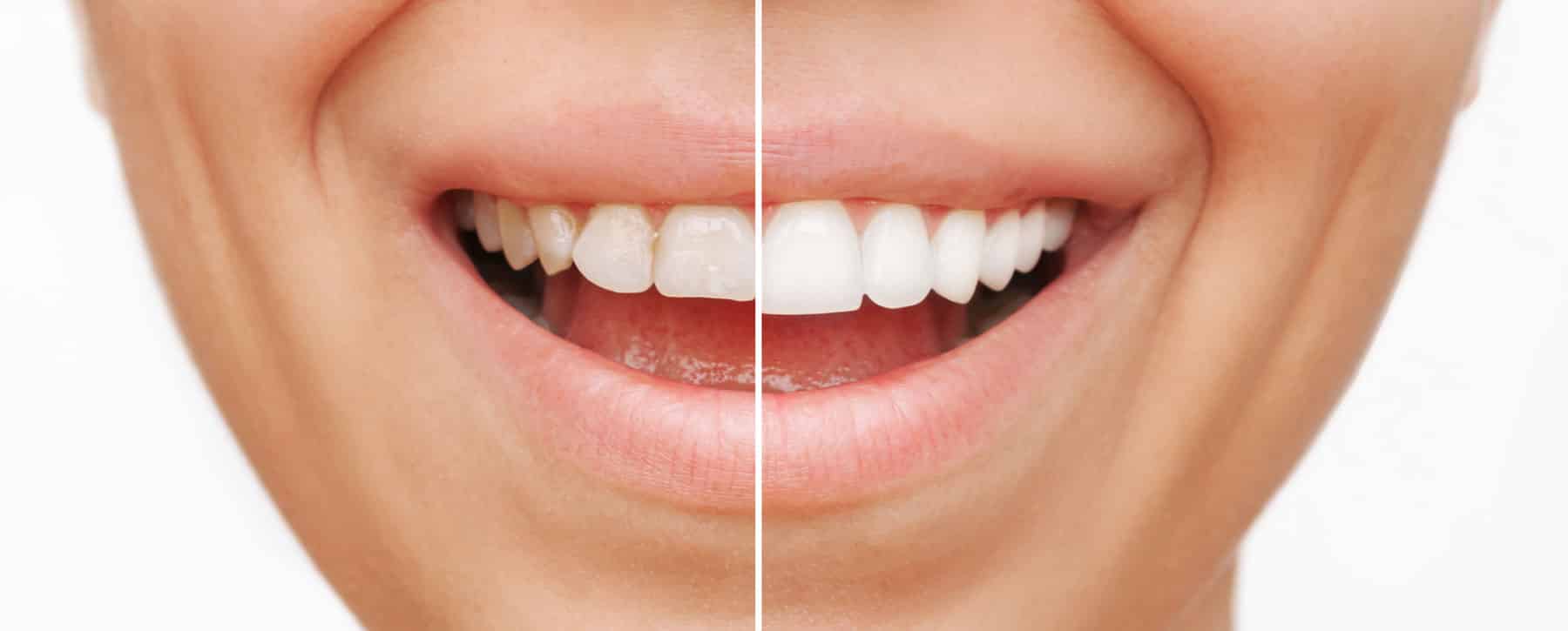 kerámia héj előtte-utána