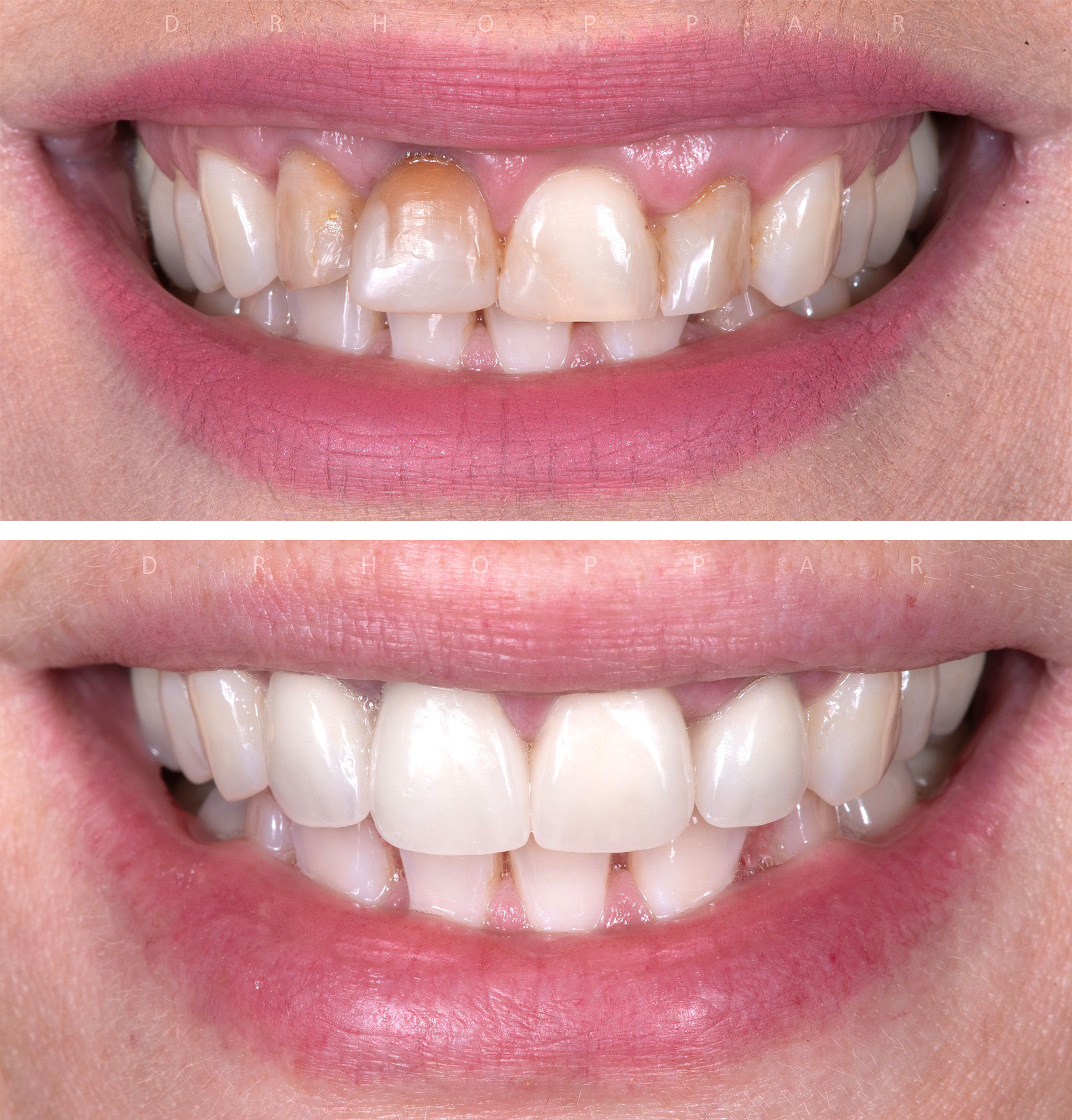 Kerémia héj előtte-utána